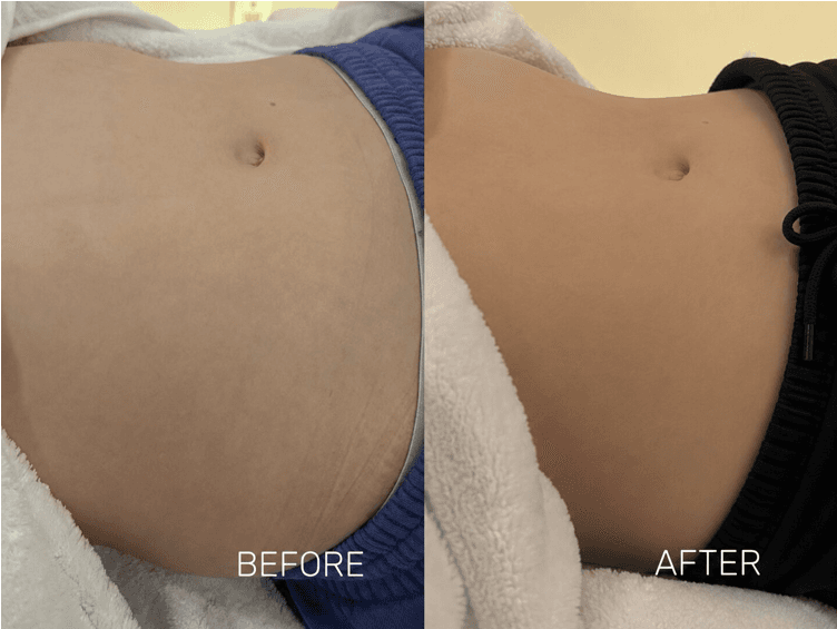 HIFEM Muscle Toning - Before and After