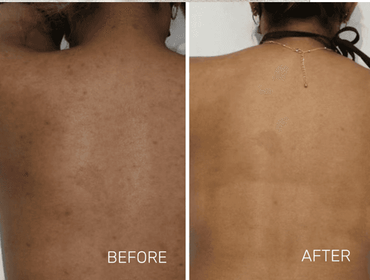 BBL / IPL Photofacial — Back - Before and After