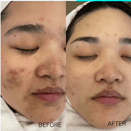 BBL / IPL Photofacial - Before and After