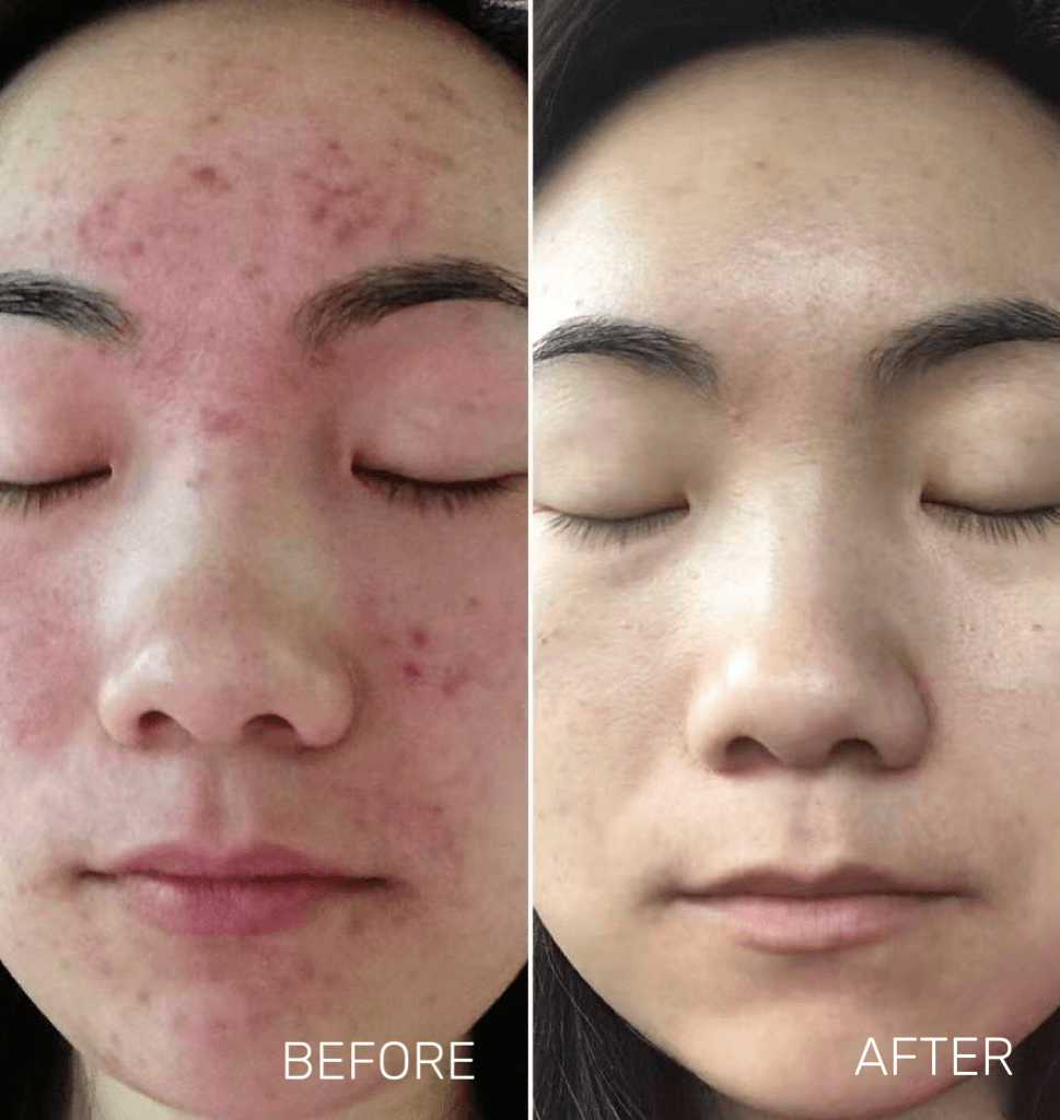 Microneedling - Before and After