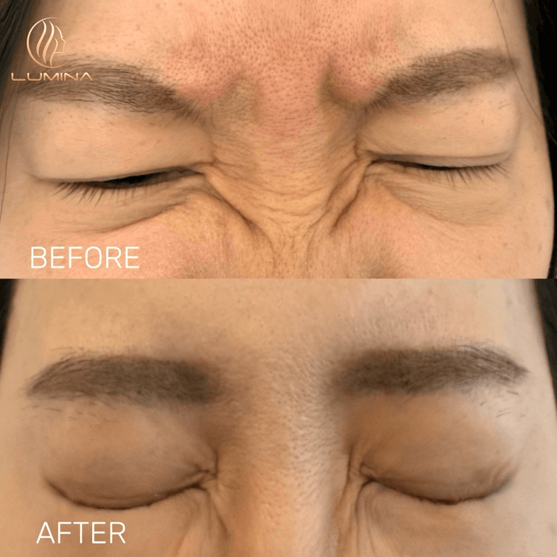 Botox / Dysport - Before and After