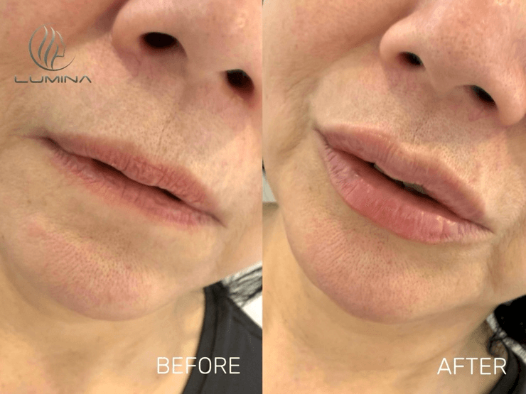 Lip Filler - Before and After